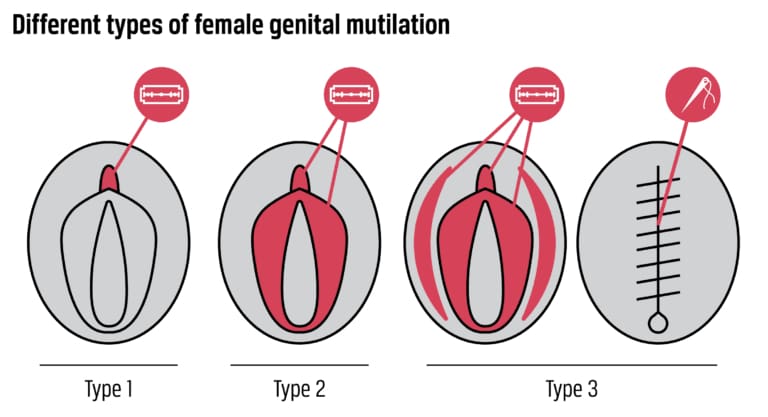 Fgm C Types